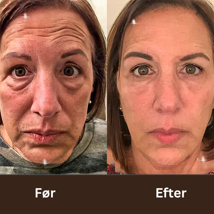 BOTOX™ Anti-rynke creme