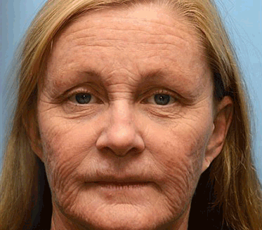 DermaLift™ - Botox Wrinkle Removal Cream