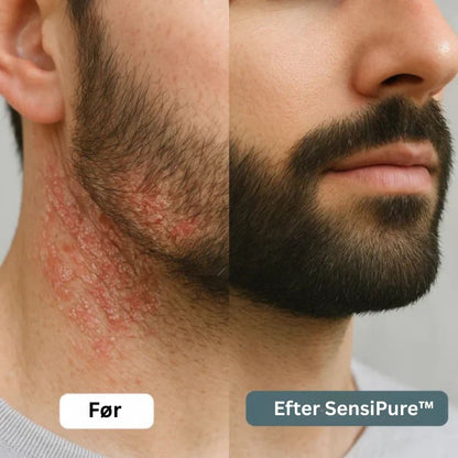 SensiPure™ – Daglig creme – Fra kløe og irritation til sund hud på 6 dage