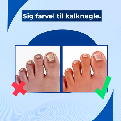 NegleFri™ | UV-laser mod neglesvamp | Klinisk bevist teknologi der bekæmper svampen ved kilden