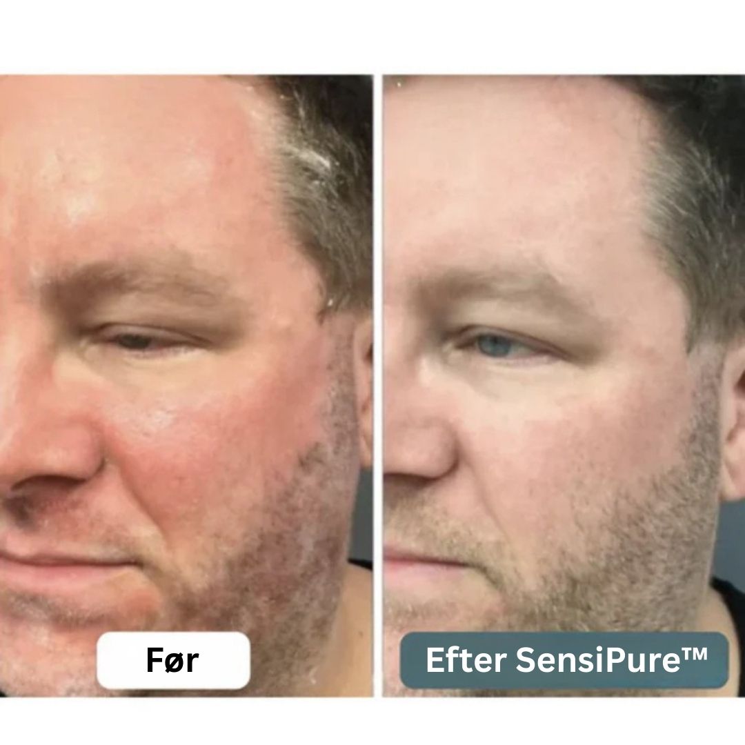 SensiPure™ – Daglig creme – Fra kløe og irritation til sund hud på 6 dage