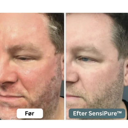 SensiPure™ – Daglig creme – Fra kløe og irritation til sund hud på 6 dage
