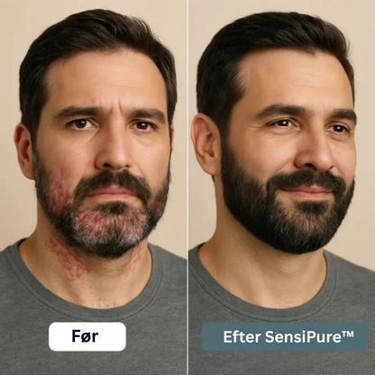 SensiPure™ – Daglig creme – Fra kløe og irritation til sund hud på 6 dage