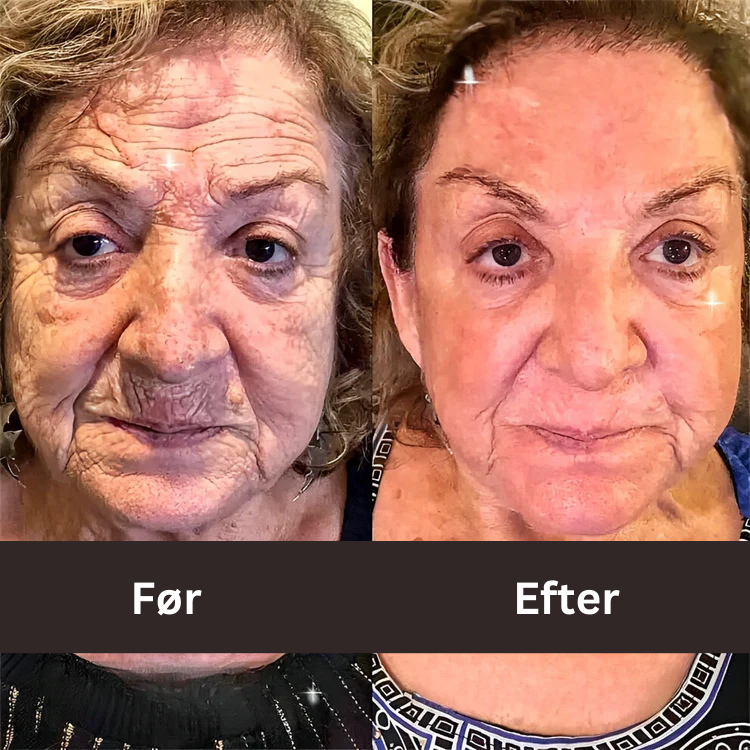 BOTOX™ Anti-rynke creme