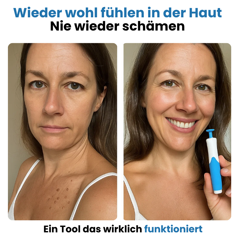 ALCURA™ Komplet Sæt – Aldrig mere hudflapper